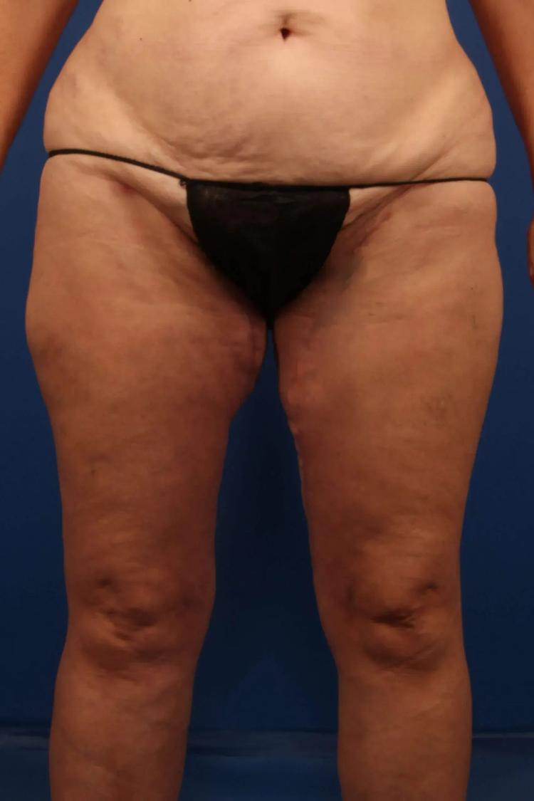 Thigh Lift (Medial) after