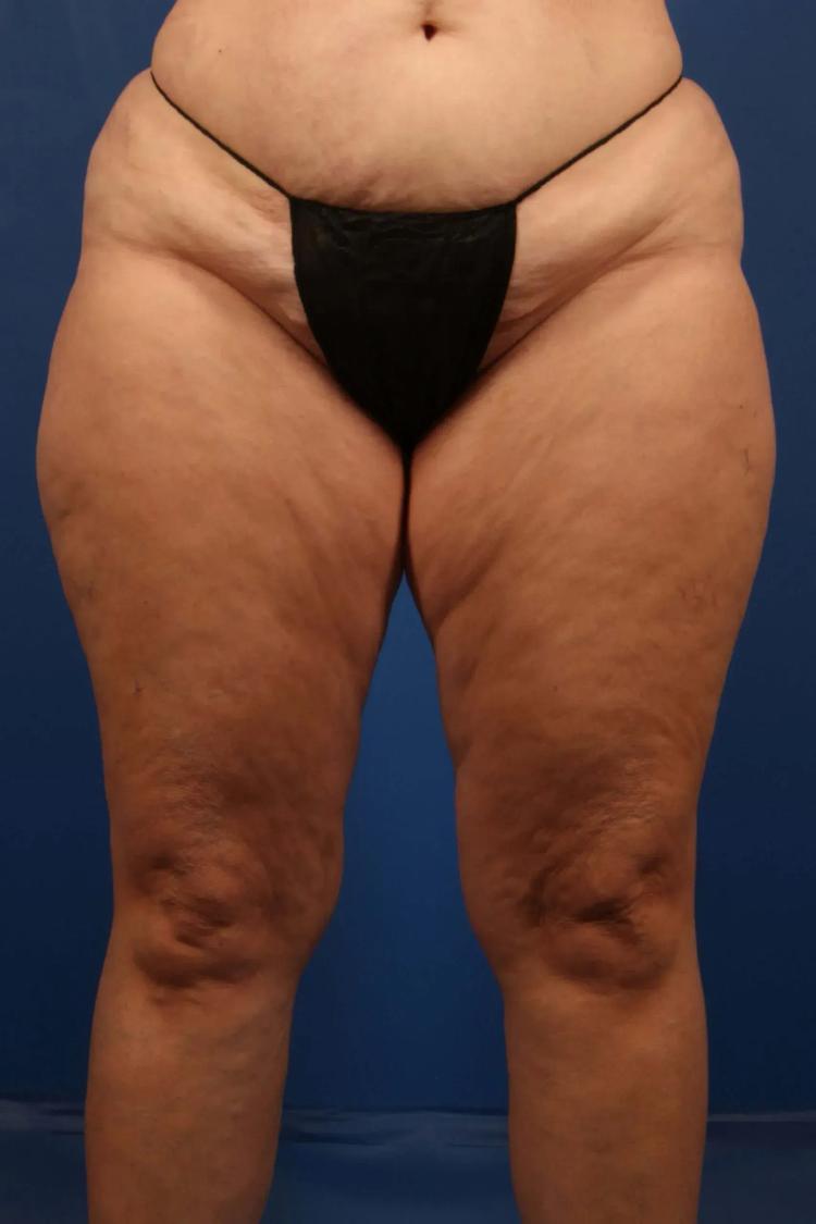 Thigh Lift (Medial) before