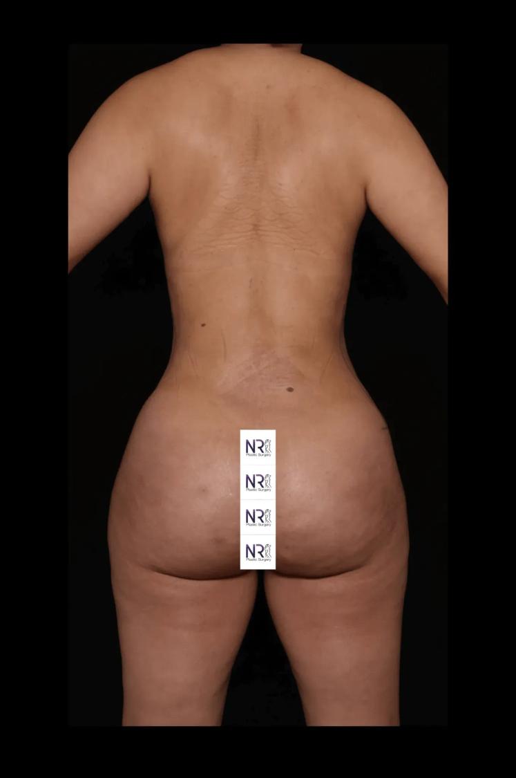 Vaser Lipo 360 (5L Max) after