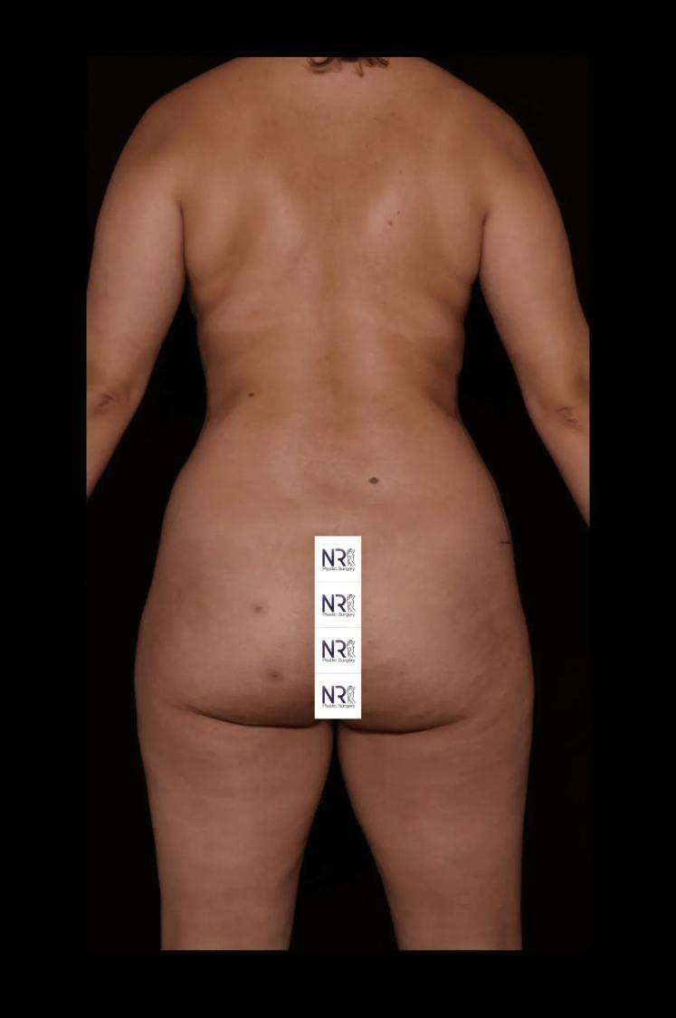 Vaser Lipo 360 (5L Max) before