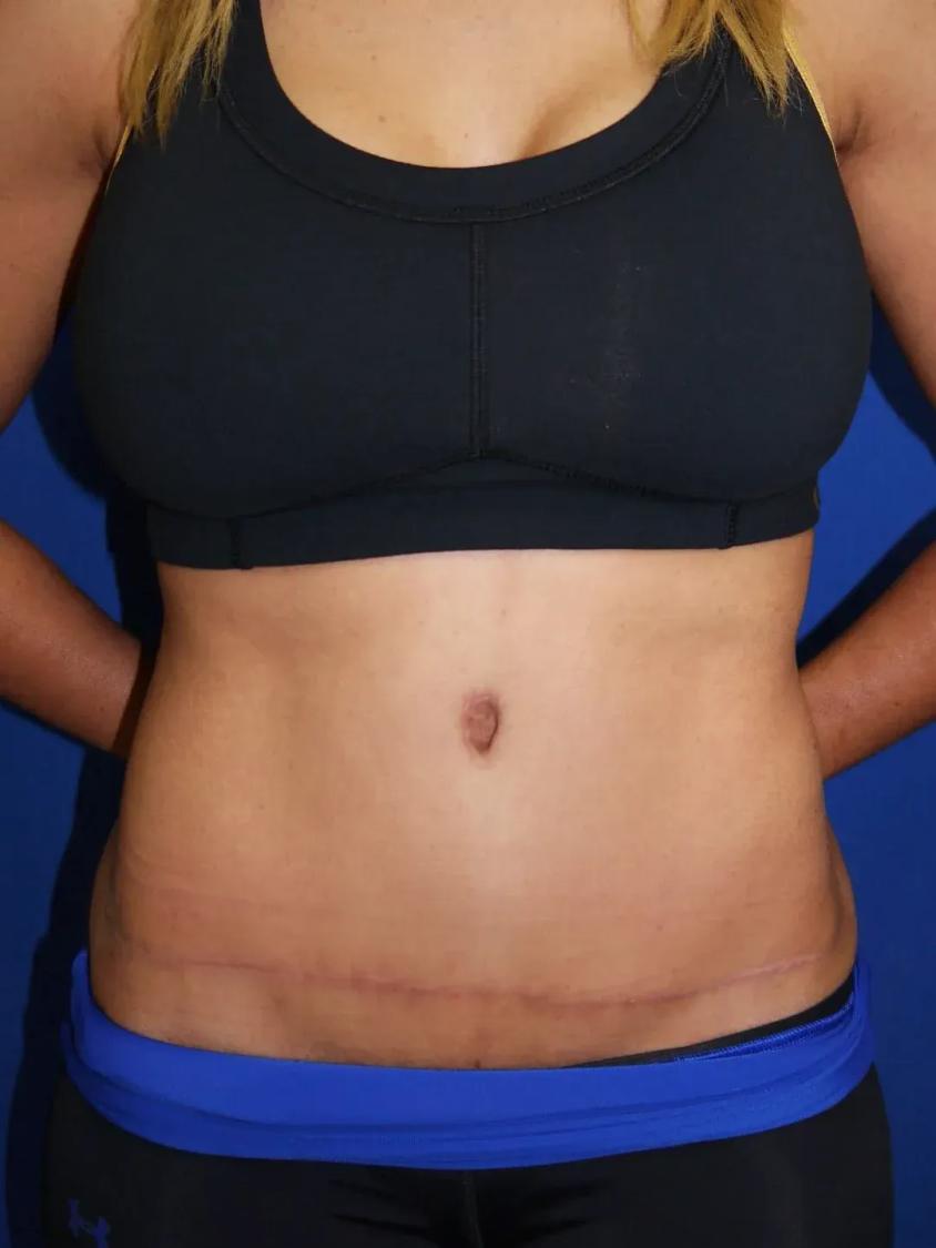 Tummy Tuck after