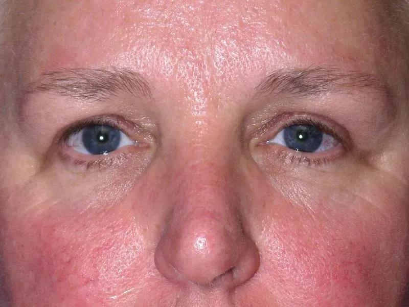 Facelift (neck lift included) after