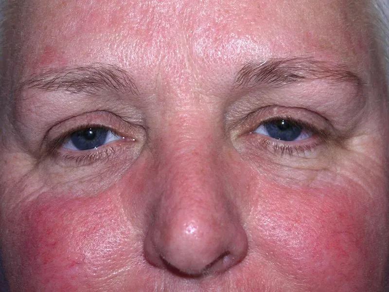 Facelift (neck lift included) before