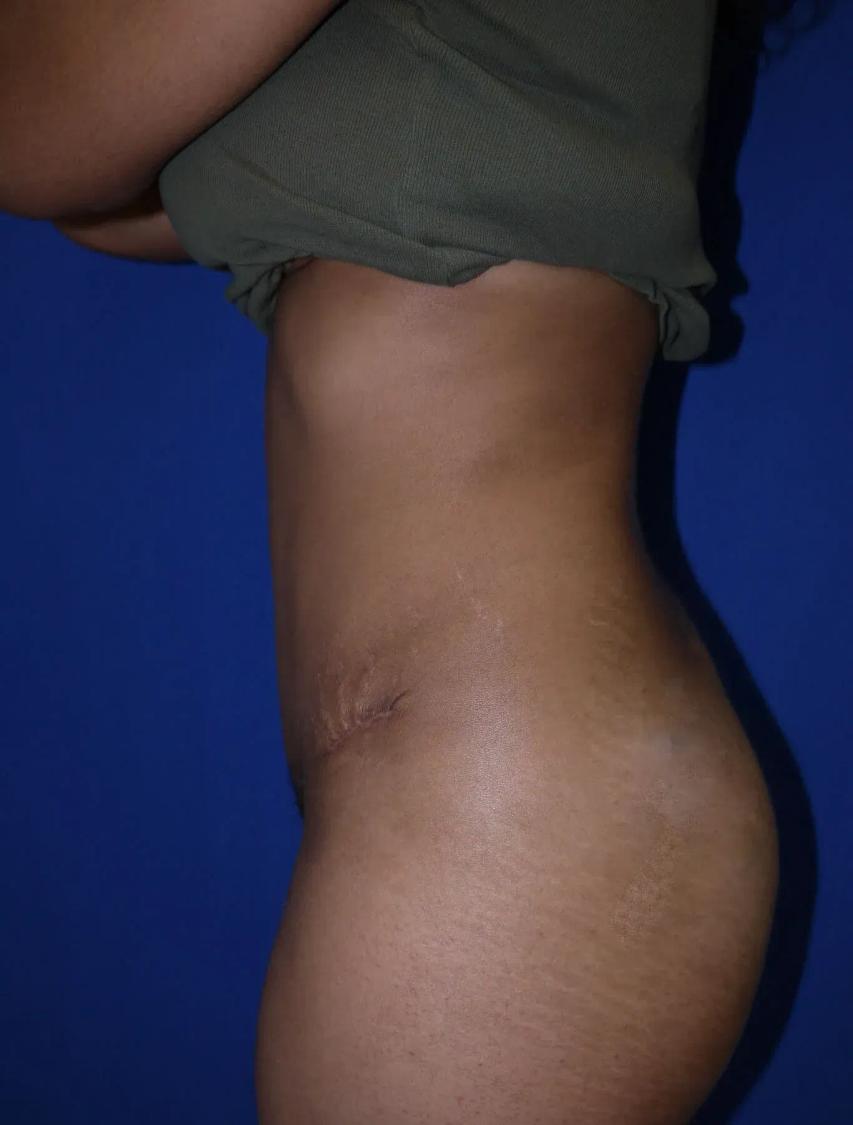 Tummy Tuck, view 4, after