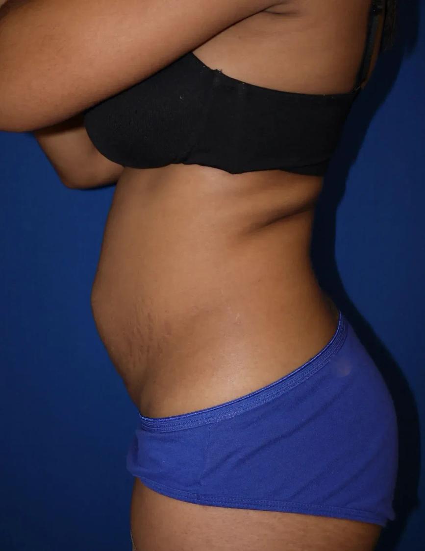Tummy Tuck, view 4, before