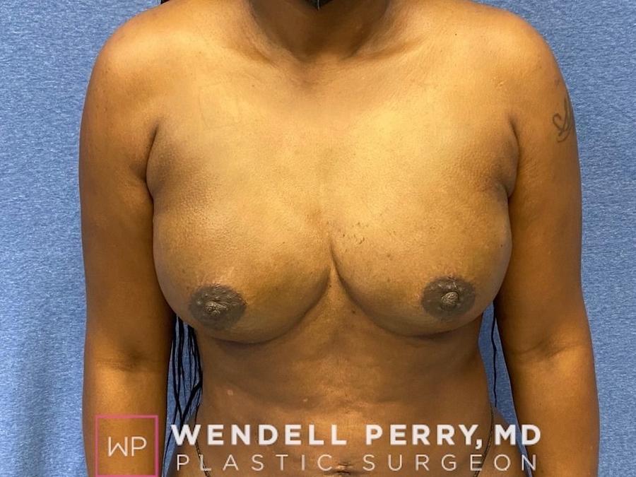 Fat Transfer To the Breast after