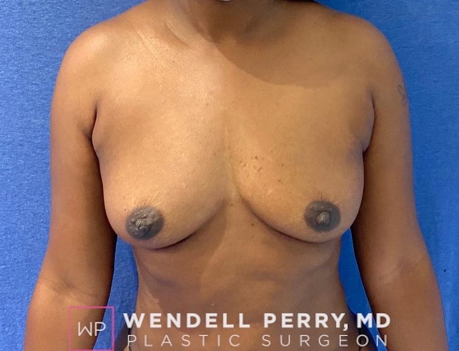 Fat Transfer To the Breast before