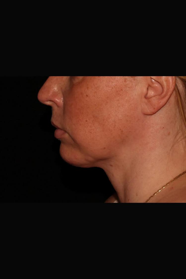 Neck Liposuction w/ Magic Tight after