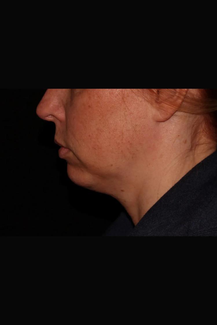 Neck Liposuction w/ Magic Tight before
