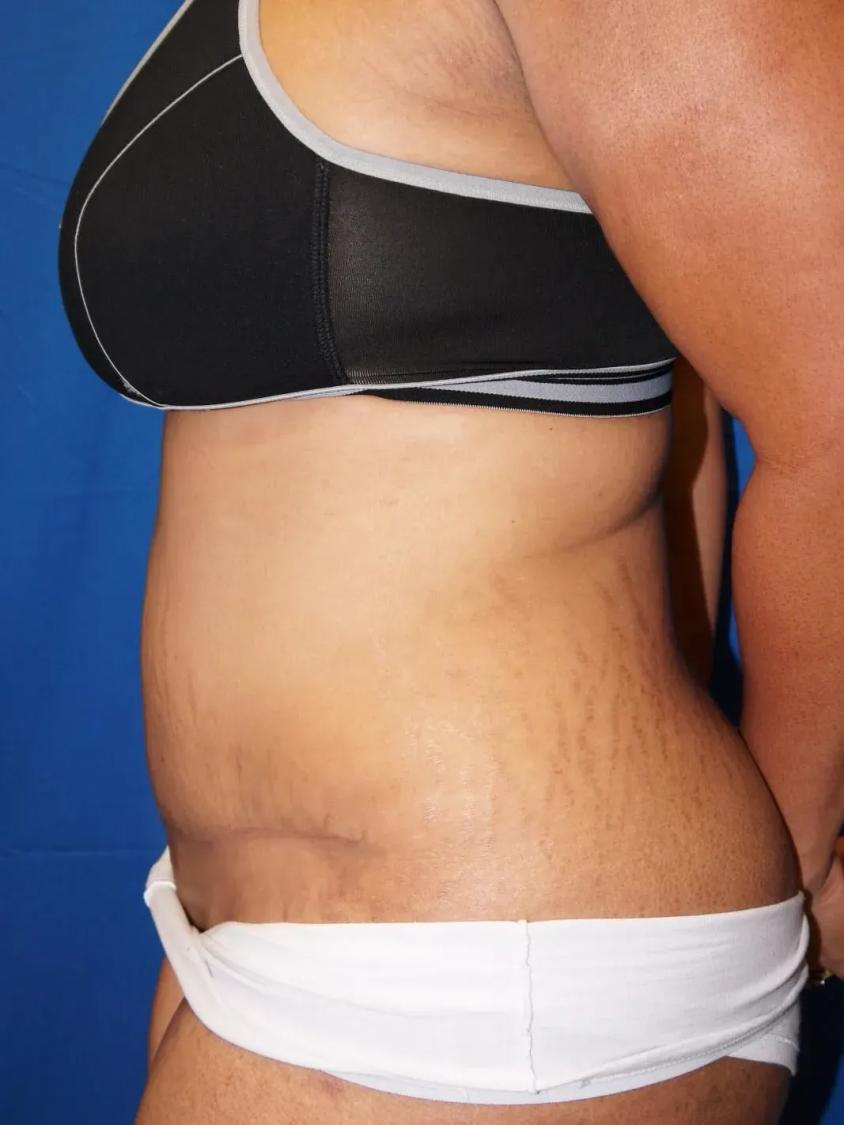 Tummy Tuck, view 2, after