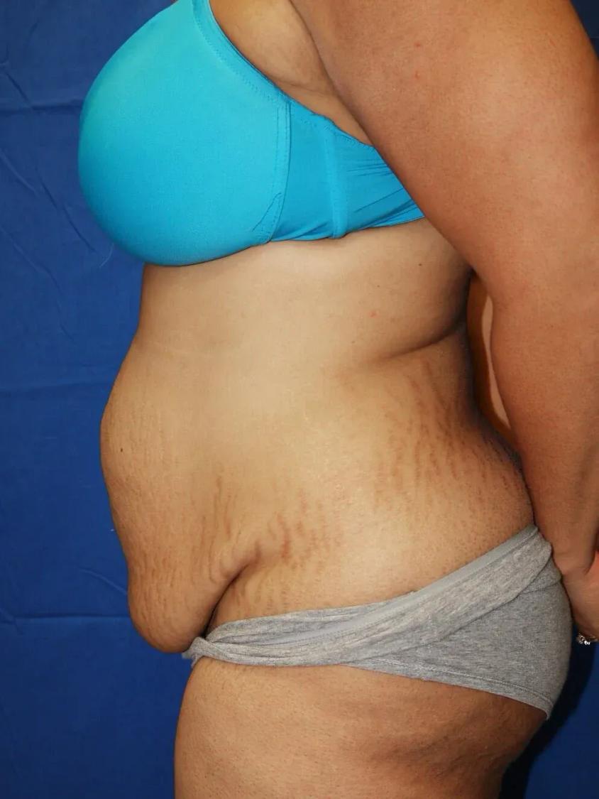 Tummy Tuck, view 2, before