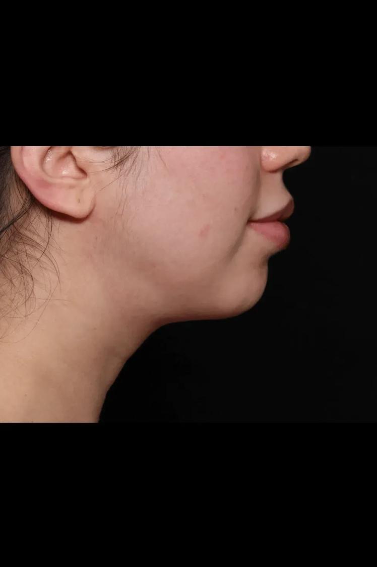 Buccal Fat Pad Removal, view 2, after