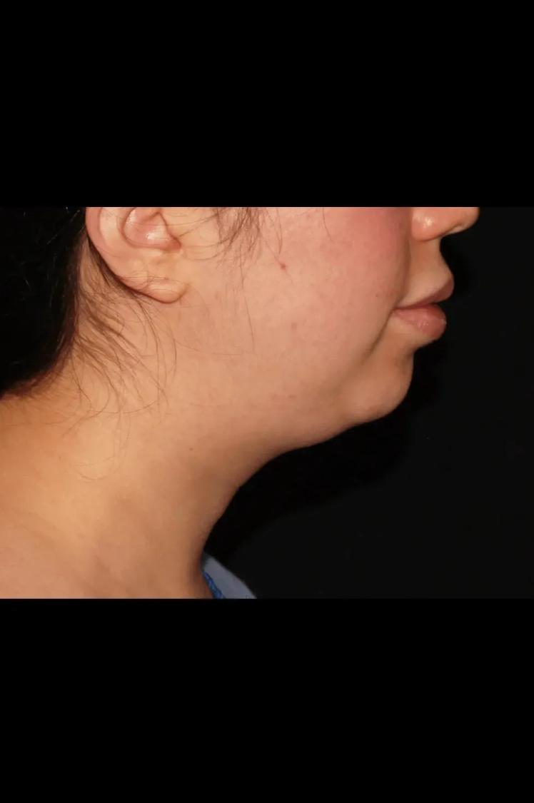 Buccal Fat Pad Removal, view 2, before