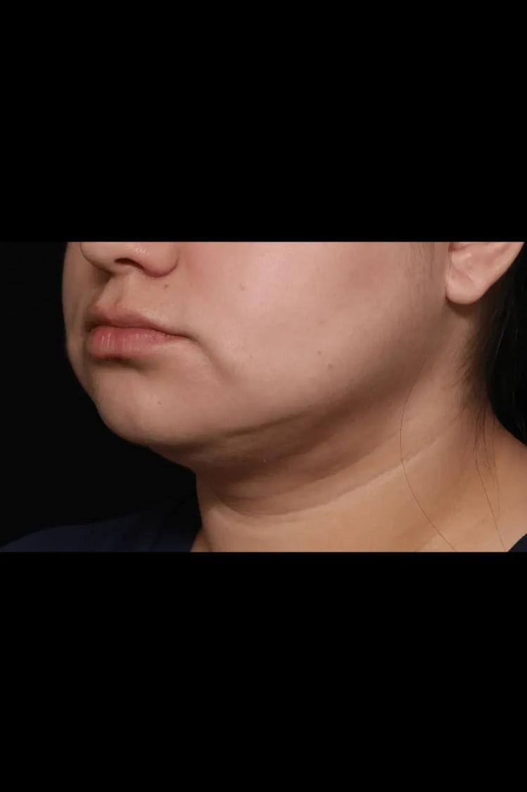 Buccal Fat Pad Removal, view 2, after