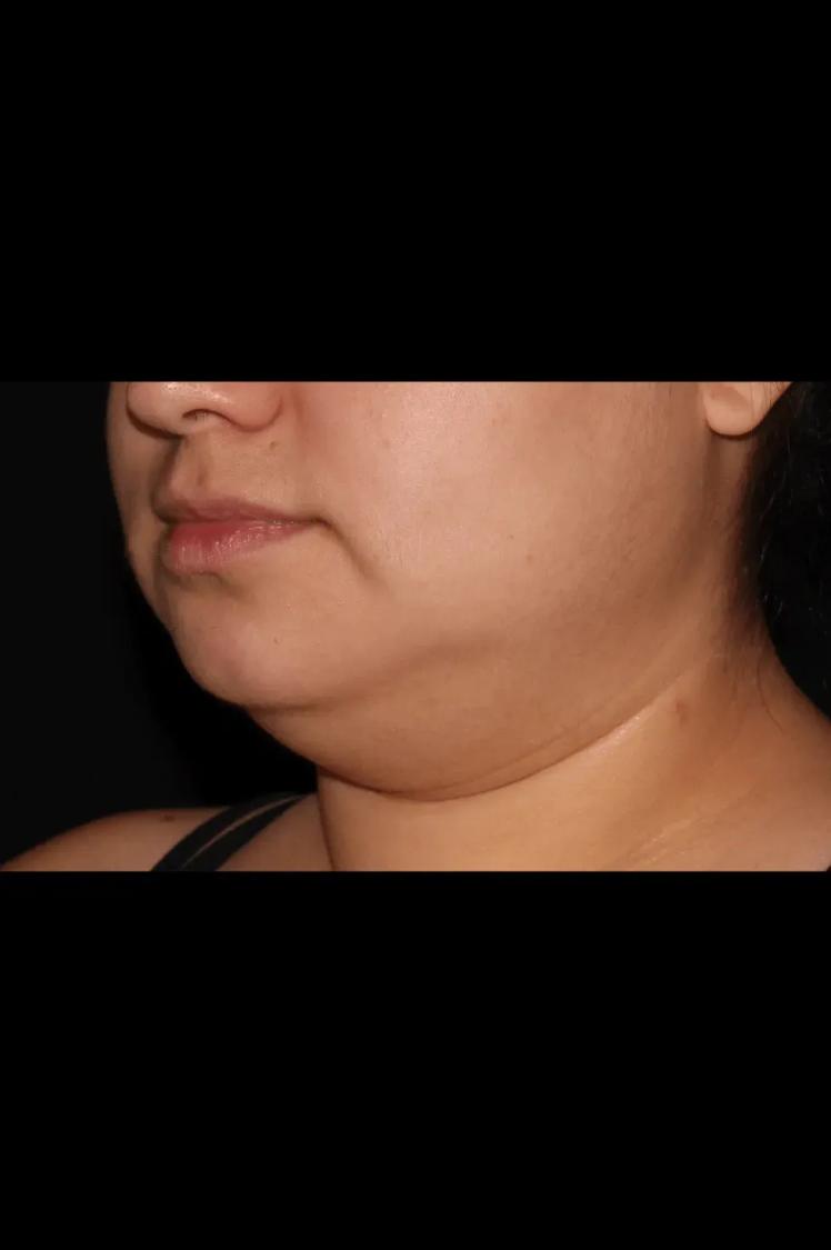 Buccal Fat Pad Removal, view 2, before