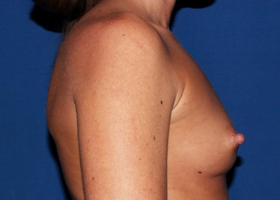 Breast Augmentation with Implants, view 3, before