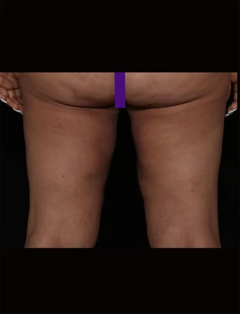 Thigh Lift (Medial) after