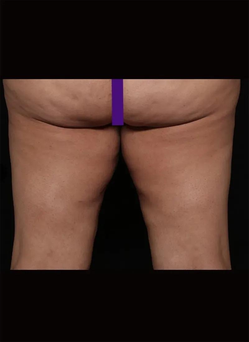 Thigh Lift (Medial) before