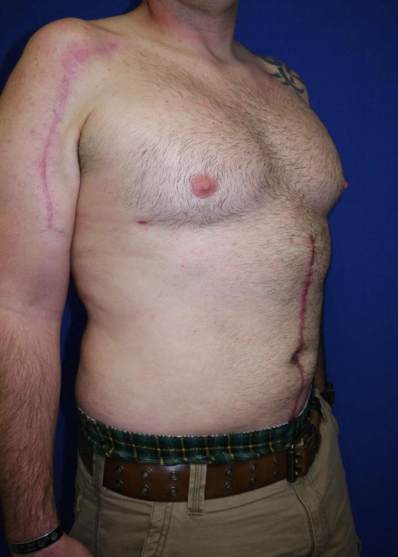 Tummy Tuck, view 2, after