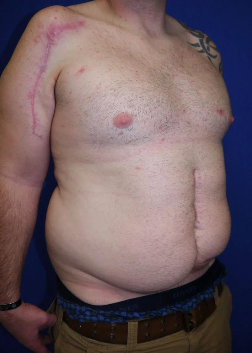 Tummy Tuck, view 2, before