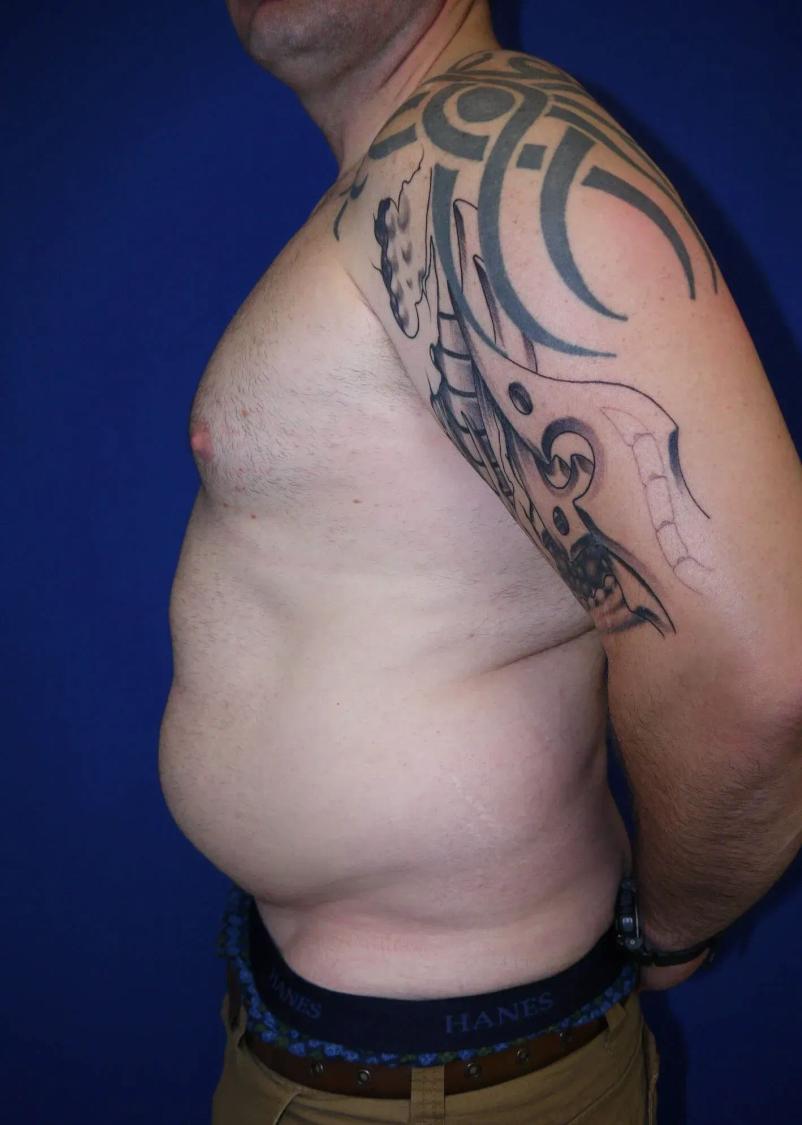 Tummy Tuck, view 4, before