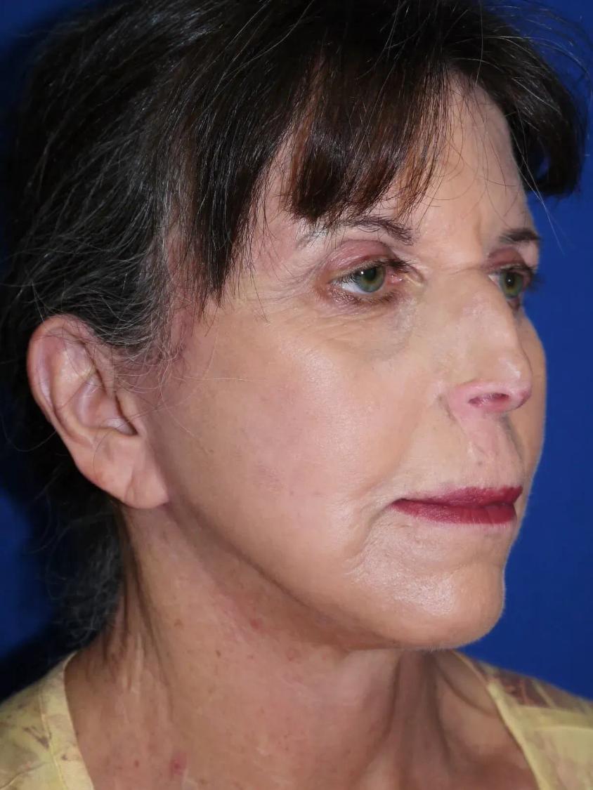 Facelift (neck lift included) after