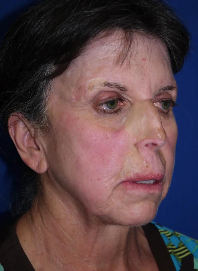Facelift (neck lift included) before