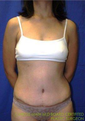Tummy Tuck after