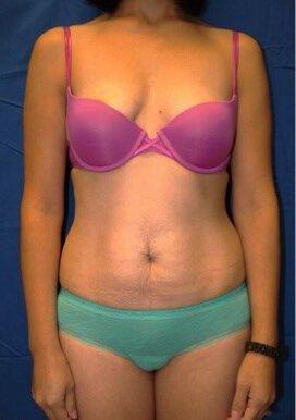 Tummy Tuck before