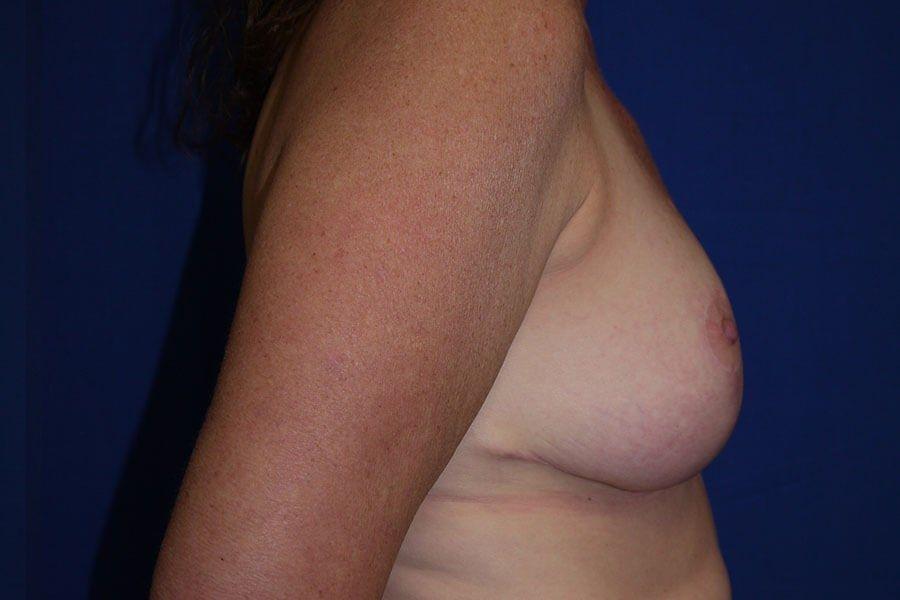 Breast Reduction, view 3, after