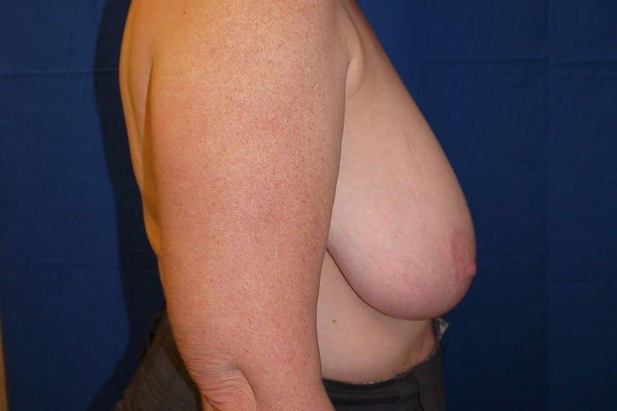 Breast Reduction, view 3, before