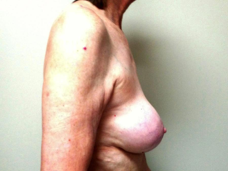 Breast Augmentation with Implants, view 3, before