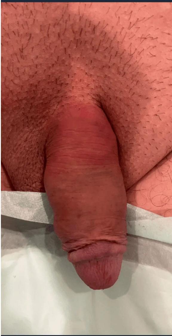 Penis Filler after