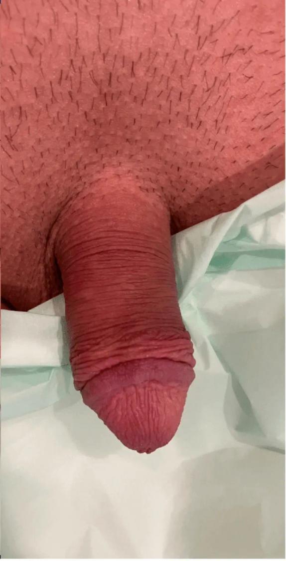 Penis Filler before
