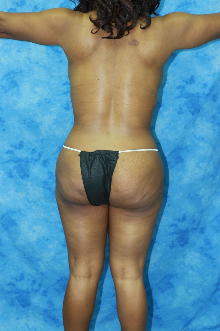 Liposuction, view 2, after