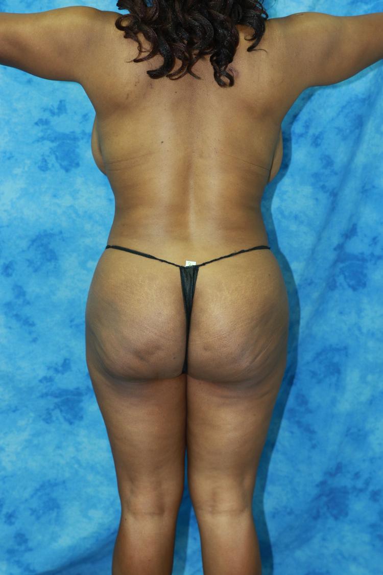 Liposuction, view 2, before
