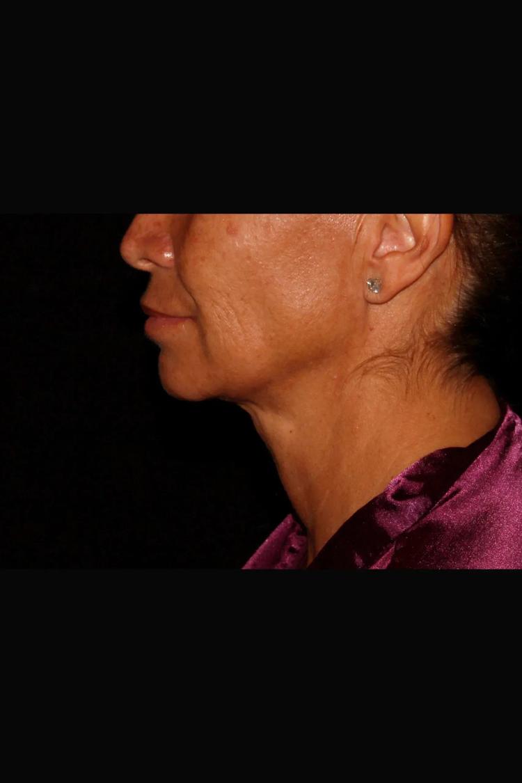 Neck Liposuction w/ Magic Tight, view 2, after