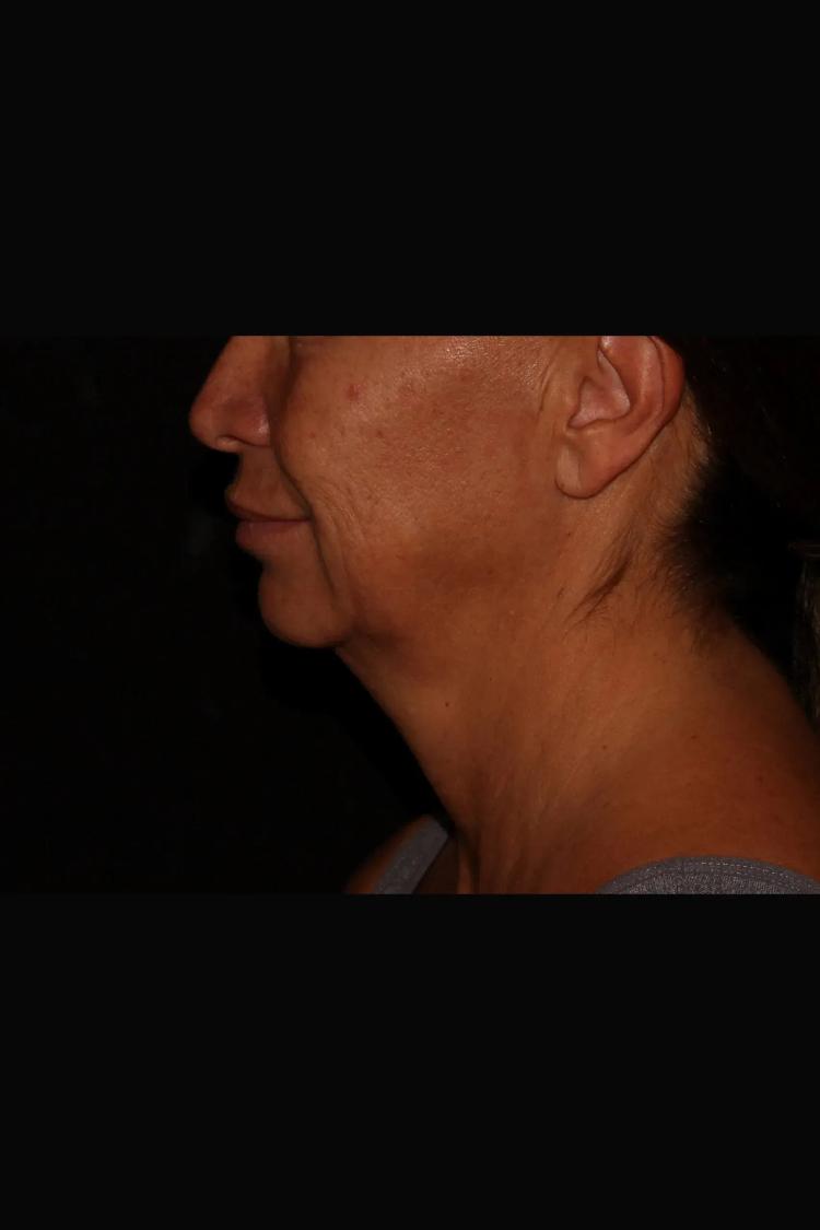 Neck Liposuction w/ Magic Tight, view 2, before