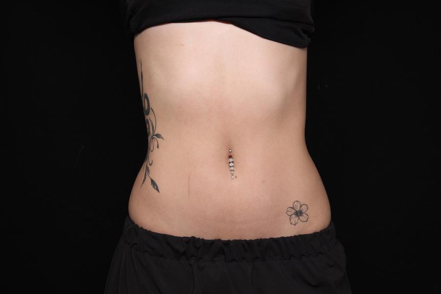 Lymphatic Drainage after