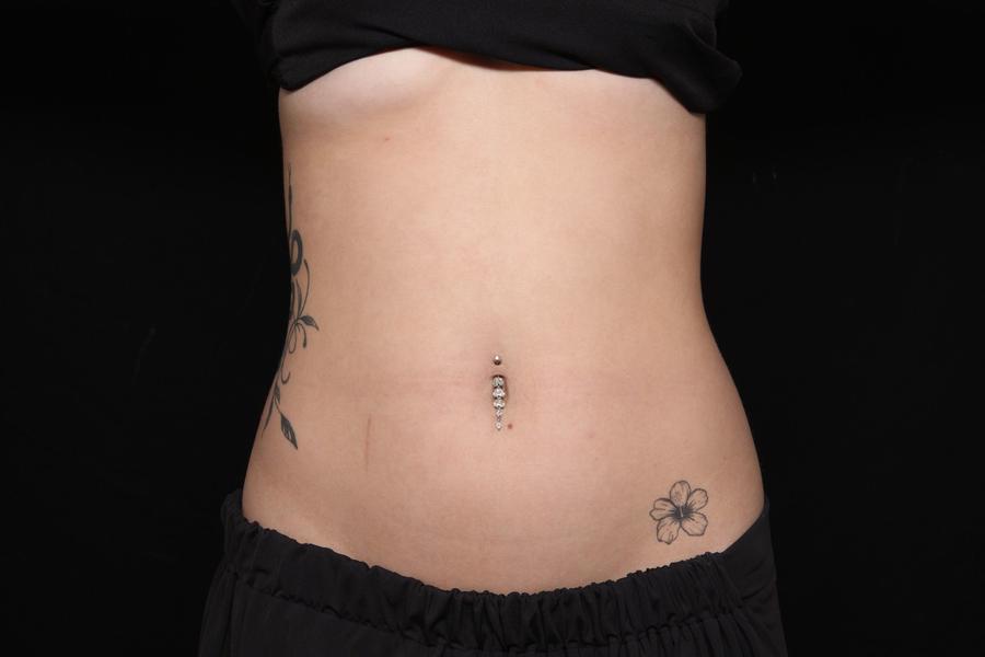 Lymphatic Drainage before
