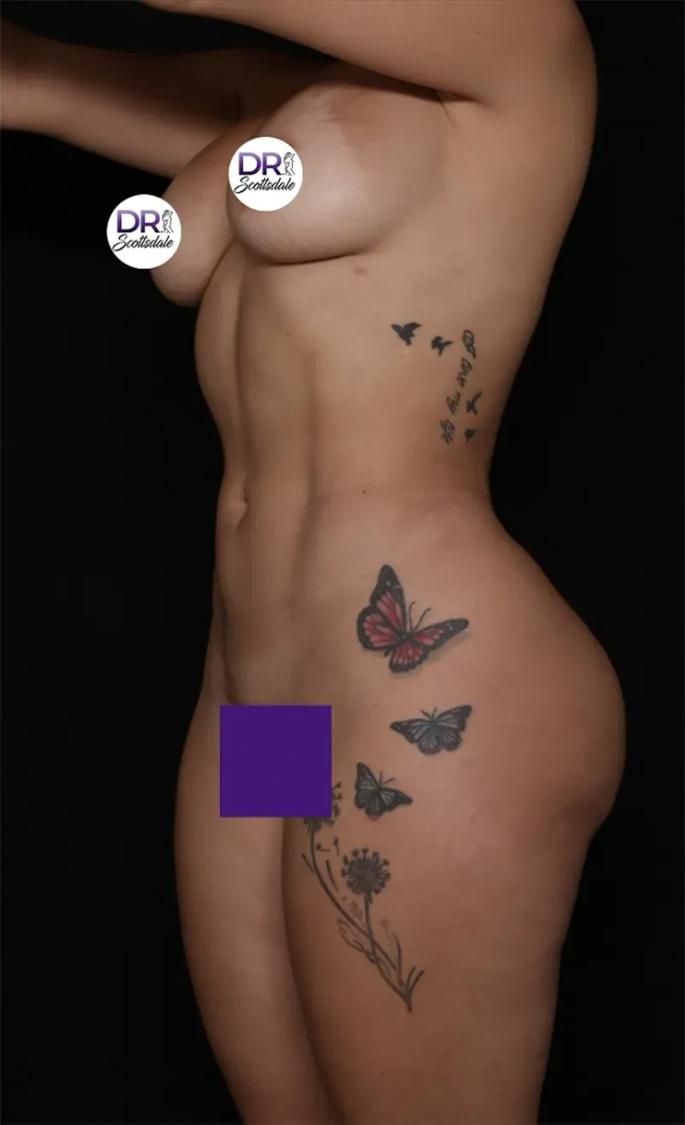 Vaser Lipo 360 (5L Max) after