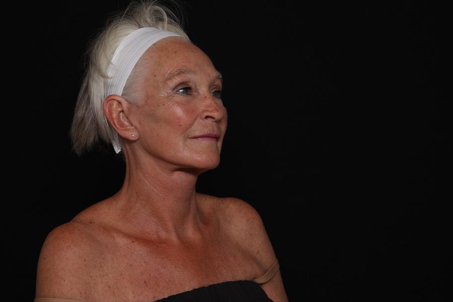 Facelift (neck lift included), view 2, after