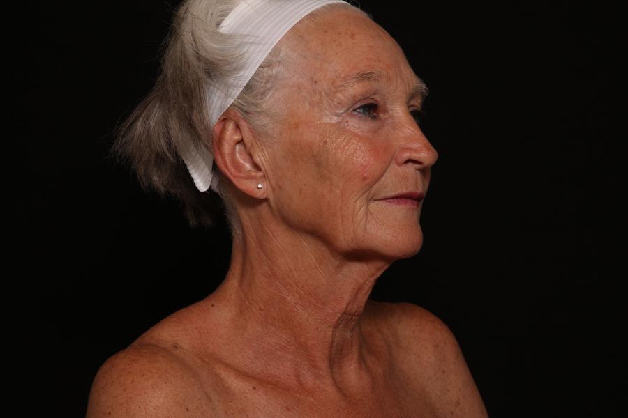 Facelift (neck lift included), view 2, before