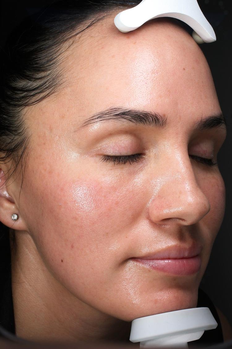 CryoTouch MD after