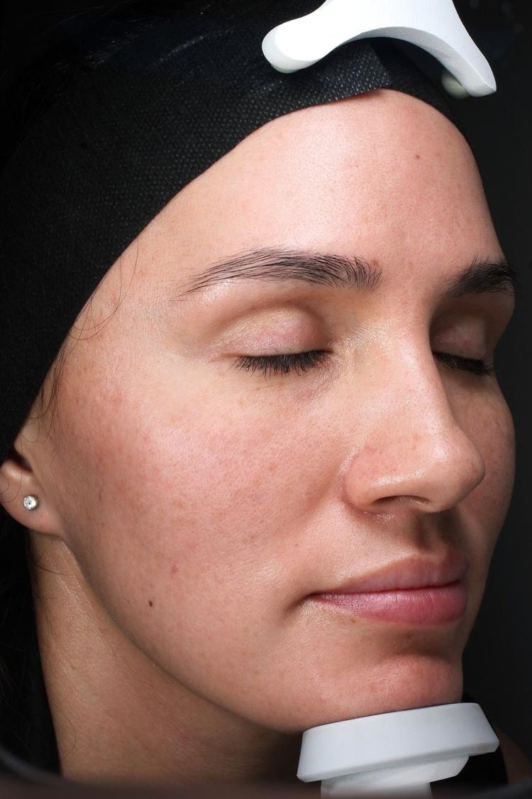 CryoTouch MD before