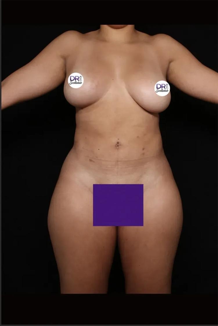 Front Liposuction (5L) (Same As Lipo360) after
