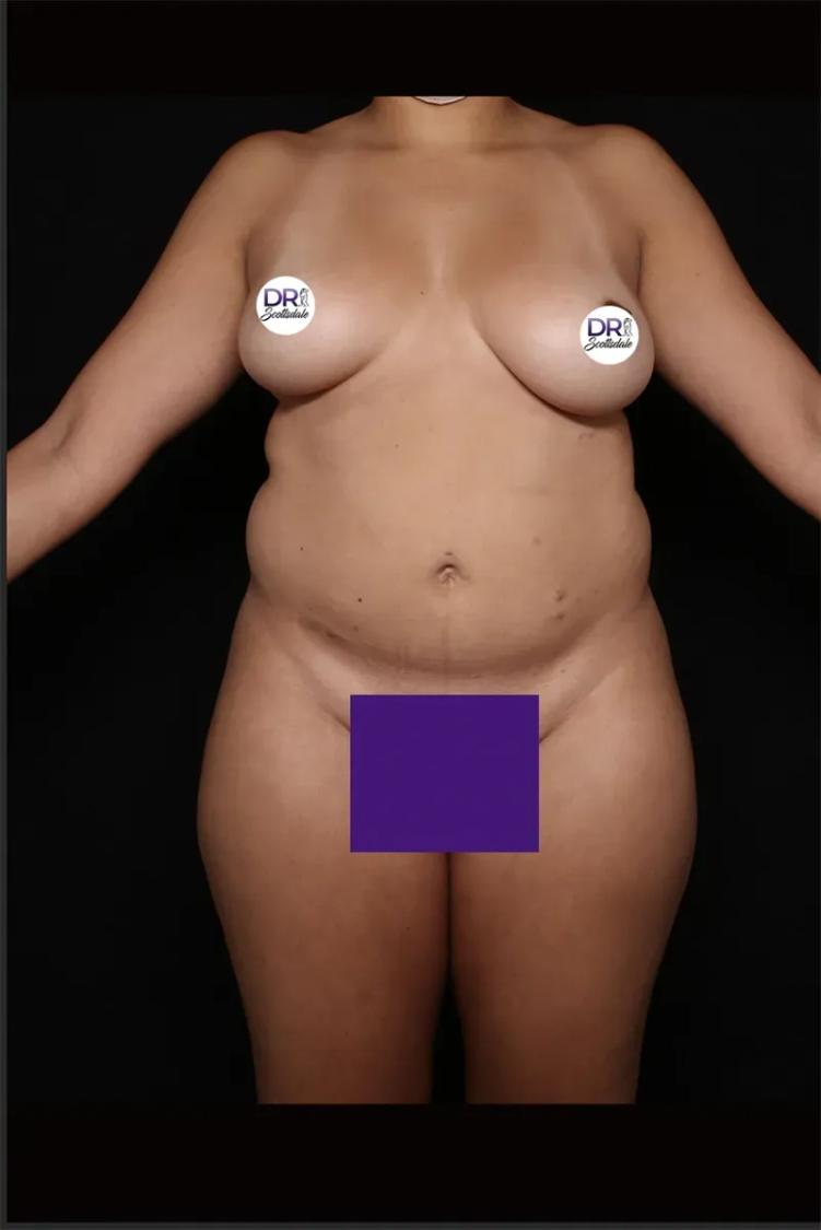 Front Liposuction (5L) (Same As Lipo360) before