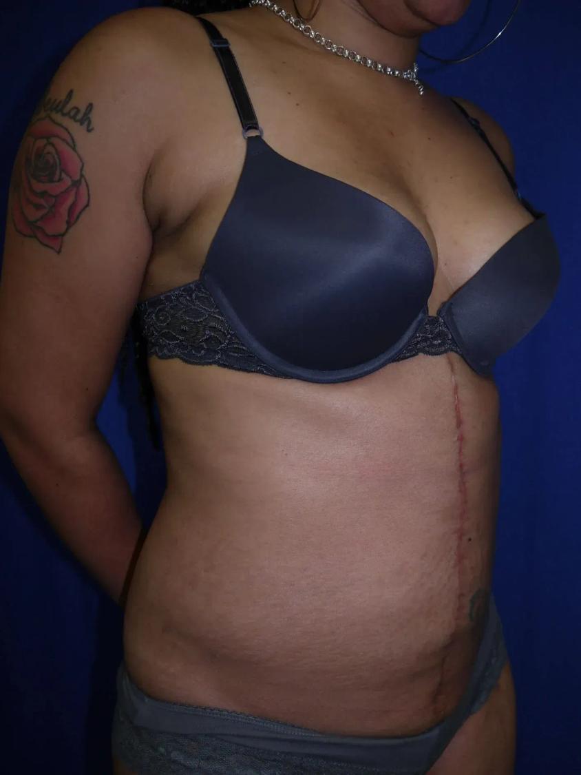 Tummy Tuck after