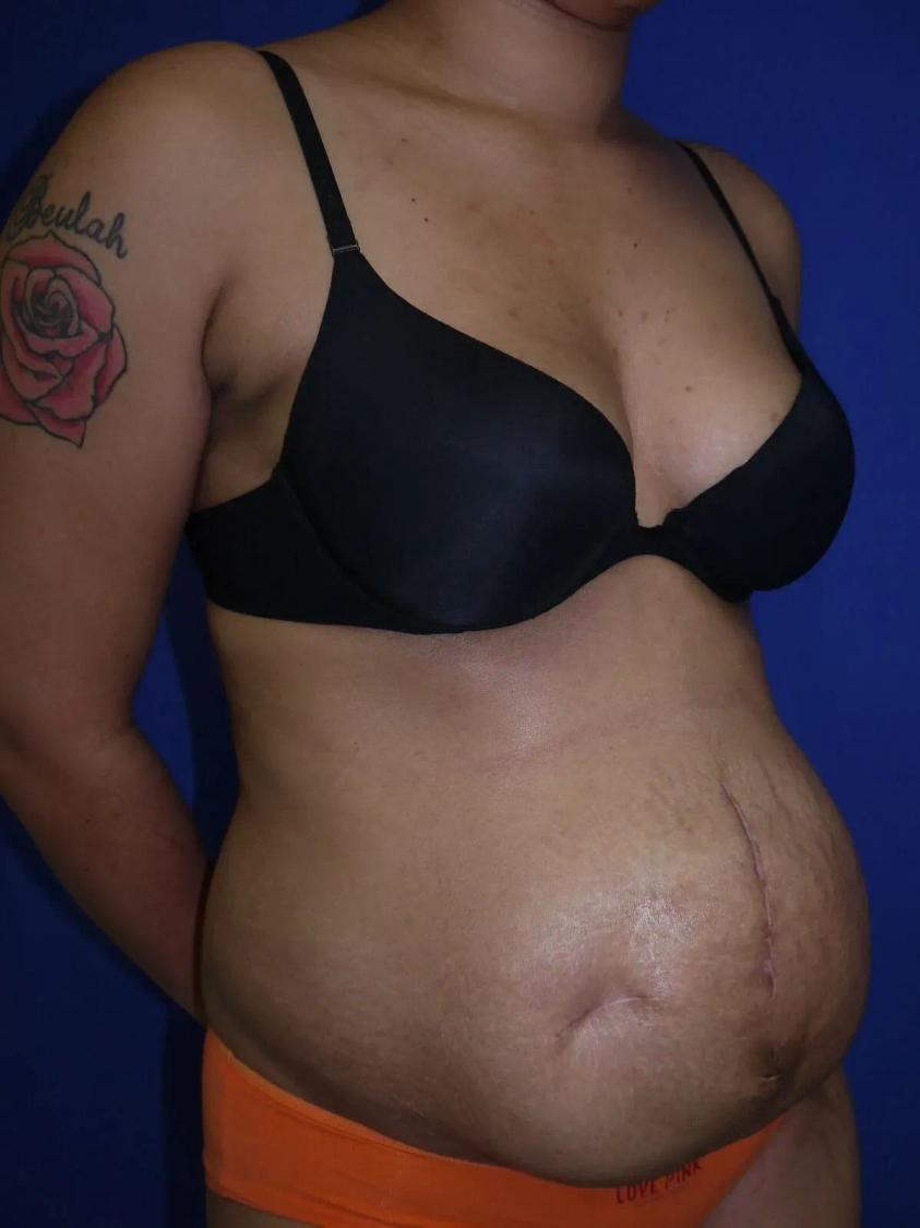 Tummy Tuck before