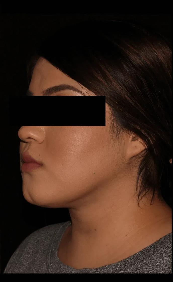 Neck Liposuction w/ Magic Tight after